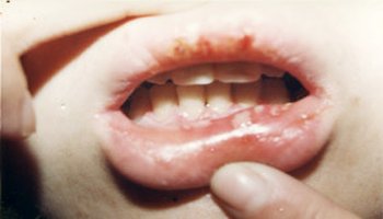 2,缺乏维生素b 小儿口腔溃疡缺乏维生素b容易引起各种口腔炎症 口角