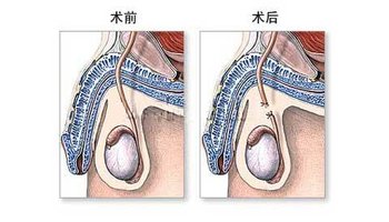 有时候,"结扎"被用于特指输精管结扎术或输卵管结扎术,这些手术早期是