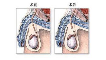 结扎