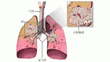 非小细胞肺癌多学科综合治疗存在地区差异|非