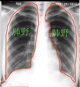 左上肺少许索条影是什么