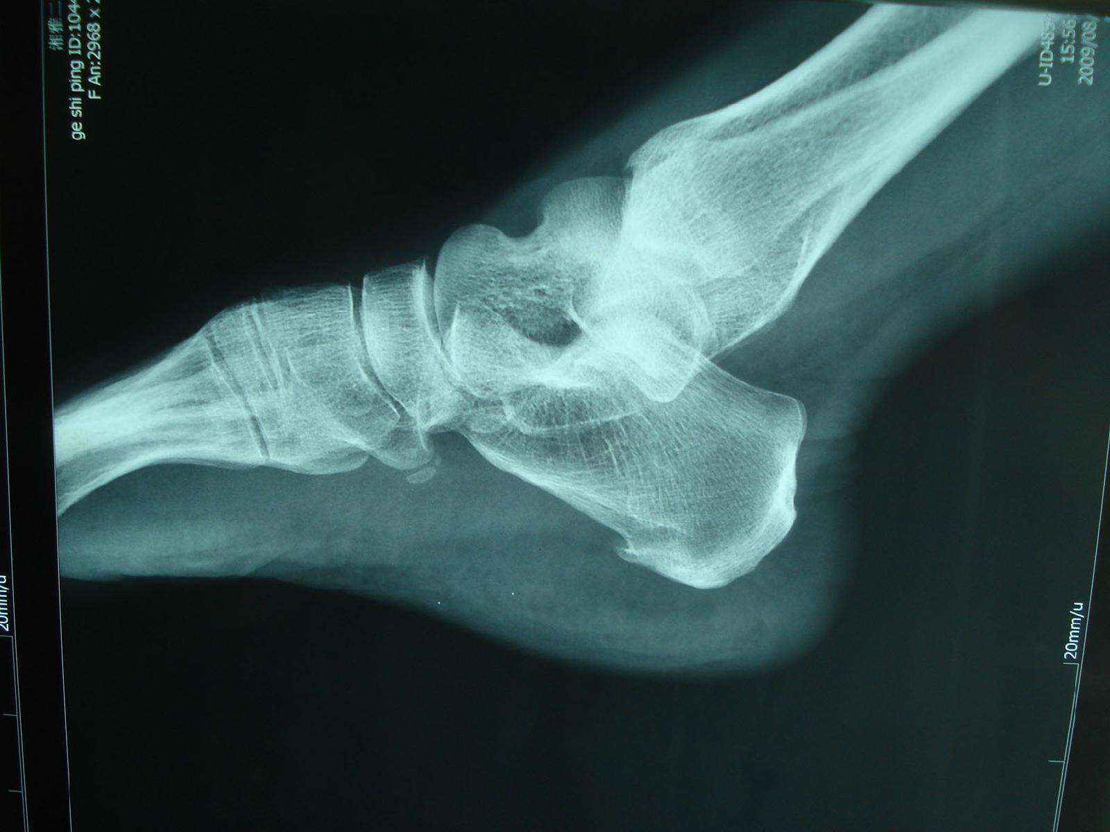 第五跖骨基底部骨折丨表现、分型、鉴别~_肌腱_病例_腓骨